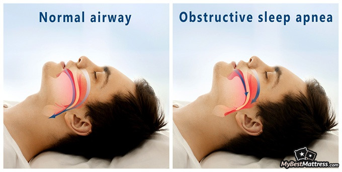 how to sleep on your back: obstructed airways How to sleep on your back: obstructed airways.